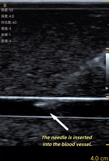초음파 혈관 천자술 훈련 모델 젤 자가복원 재료 의료  - Medical Gel Ultrasound 리뷰 및 가격